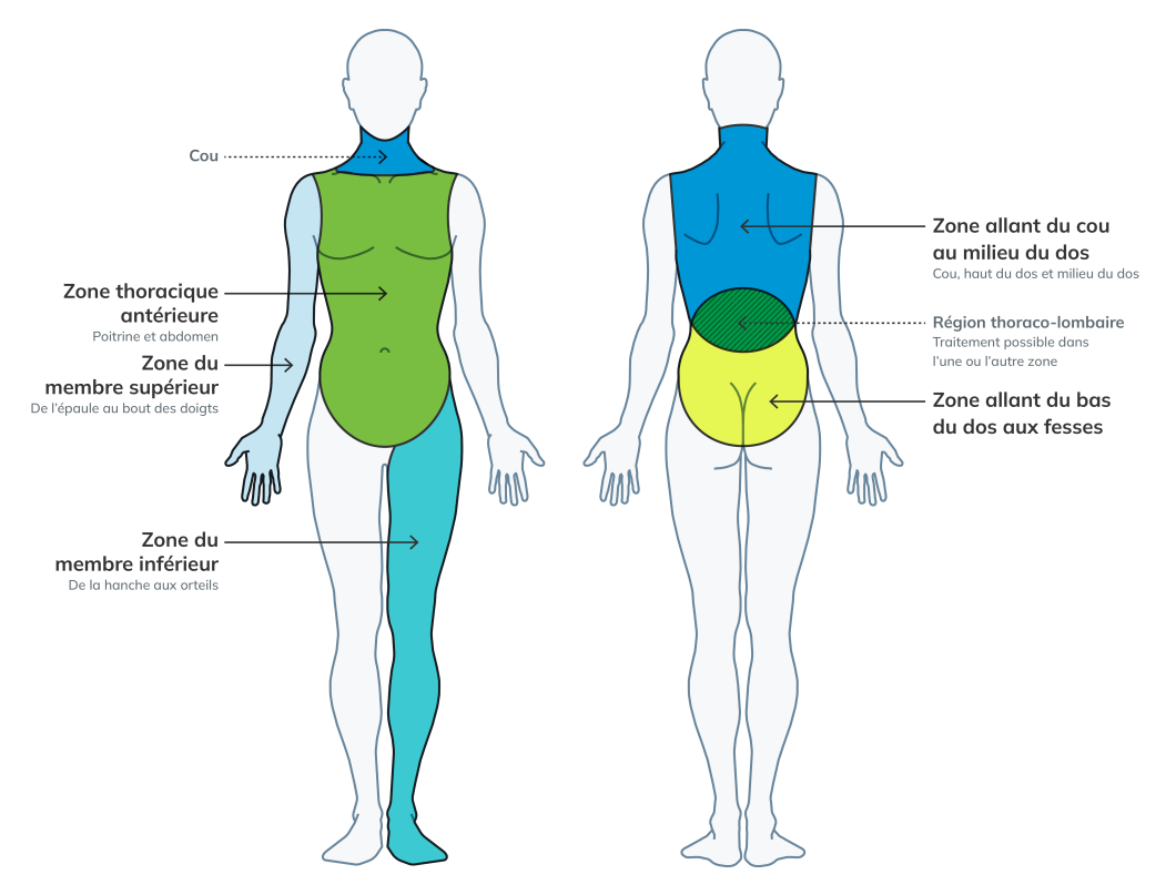 Illustration de deux corps humains, l’un tourné vers l’avant et l’autre vers l’arrière, mettant en évidence les cinq zones principales : zone thoracique antérieure, zone du membre supérieur, zone du membre inférieur, zone allant du cou au milieu du dos, et zone allant du bas du dos aux fesses.