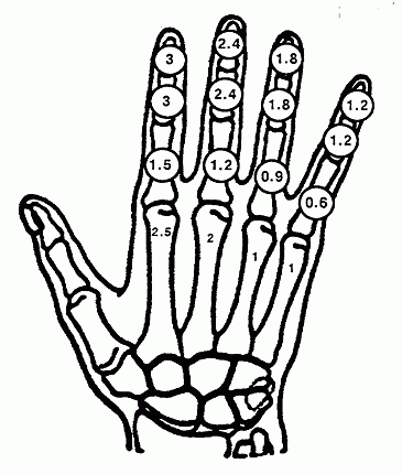 Skeletal image of the right hand with disability ratings of respective bones