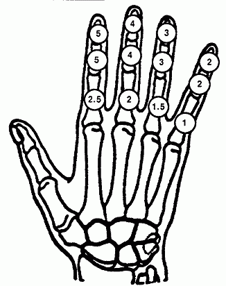 Skeletal image of the right hand with disability rating of respective bones